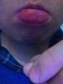 吃瓜嘴唇肿,揭秘背后的健康隐患