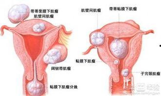 子宫肌瘤吃哈密瓜,天然食疗的养生之道
